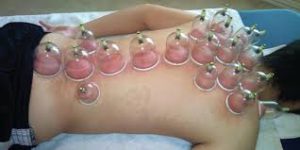 bekam kering